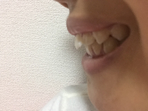 出っ歯（正面）